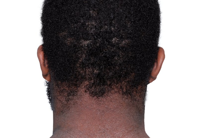 Actual 23-year-old male patient at baseline with eczema (atopic dermatitis) on back of neck.