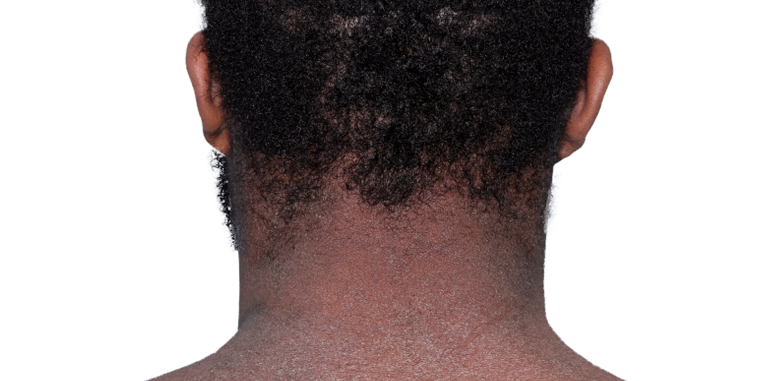 Actual 23-year-old male patient at baseline with eczema (atopic dermatitis) on back of neck.