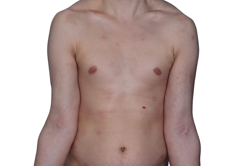 Actual 26-year-old male patient at Week 16 with improved eczema (atopic dermatitis) on chest and arms.