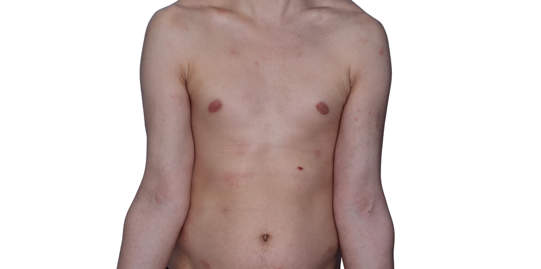 Actual 26-year-old male patient at Week 16 with improved eczema (atopic dermatitis) on chest and arms.