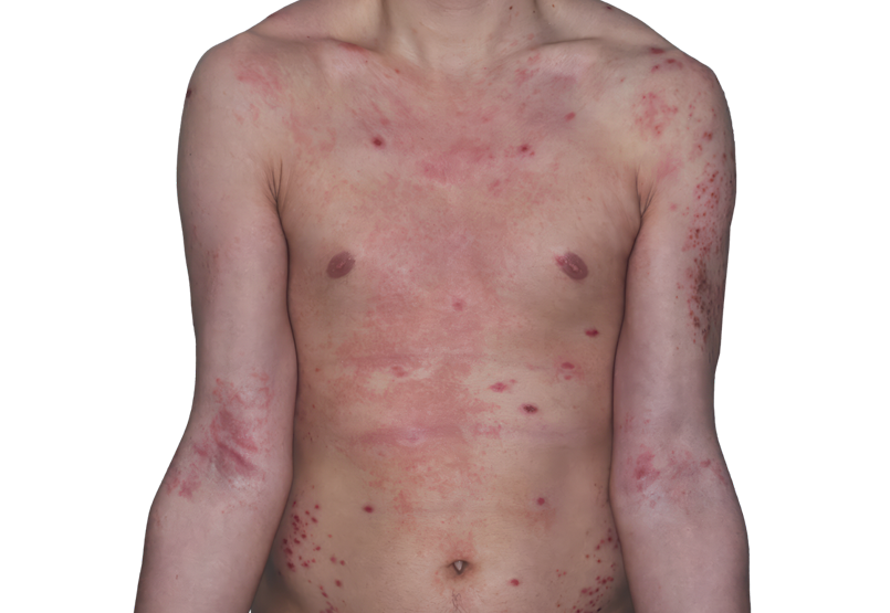 Actual 26-year-old male patient at baseline with eczema (atopic deramtitis) on arms and chest.