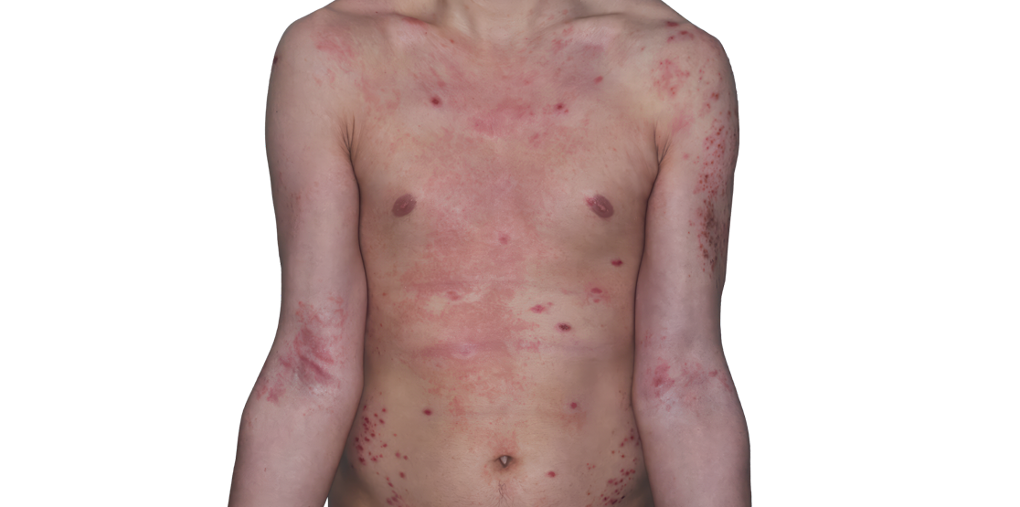 Actual 26-year-old male patient at baseline with eczema (atopic deramtitis) on arms and chest.