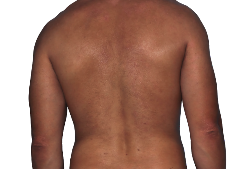 Actual 42-year-old male patient at Week 16 with improved eczema (atopic dermatitis) on back and arms.