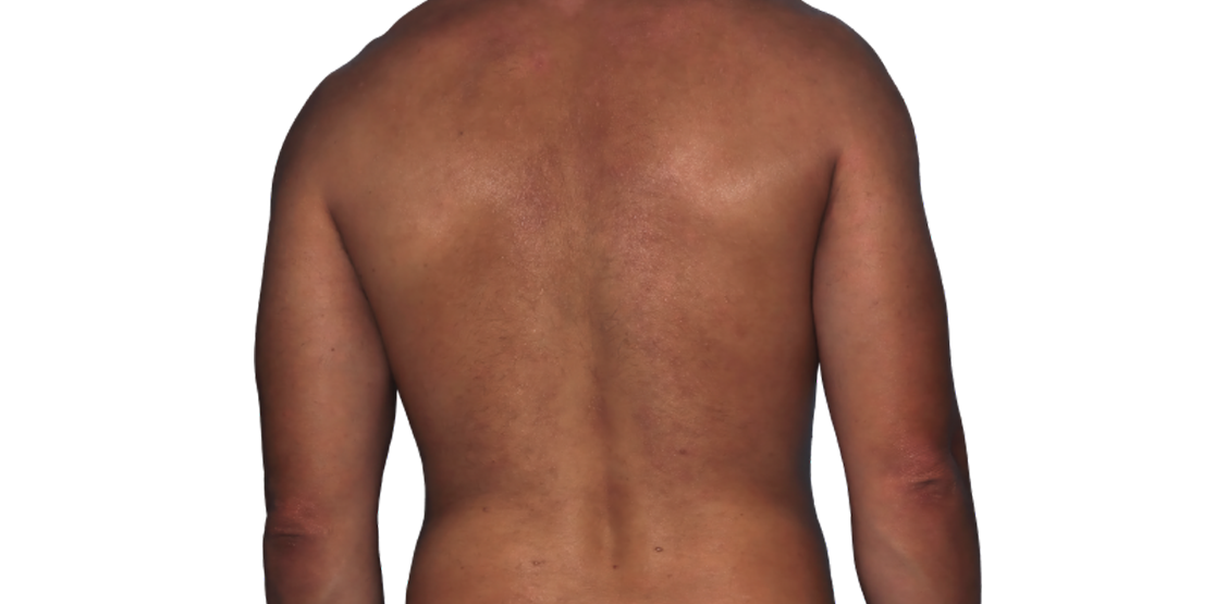 Actual 42-year-old male patient at Week 16 with improved eczema (atopic dermatitis) on back and arms.