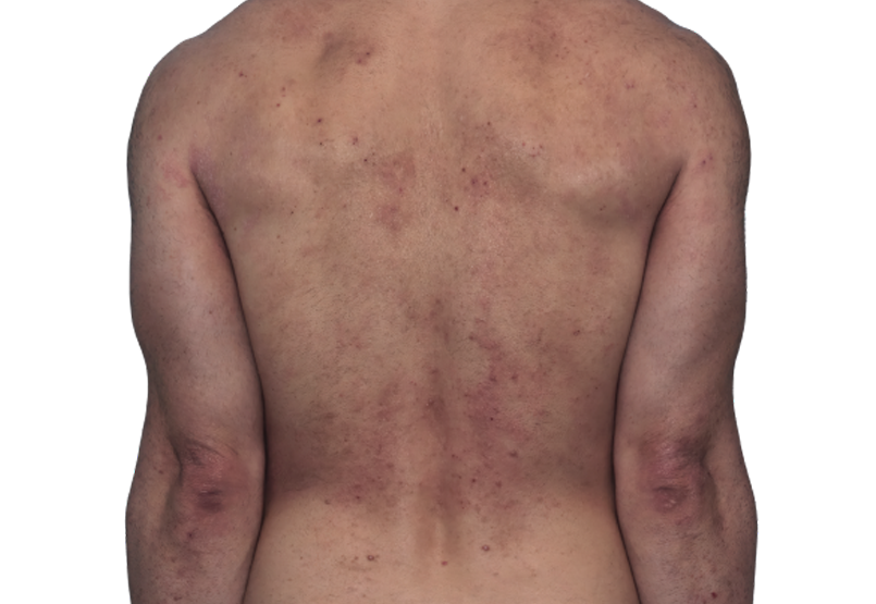 Actual 42-year-old male patient at baseline with eczema (atopic dermatitis) on back and arms.