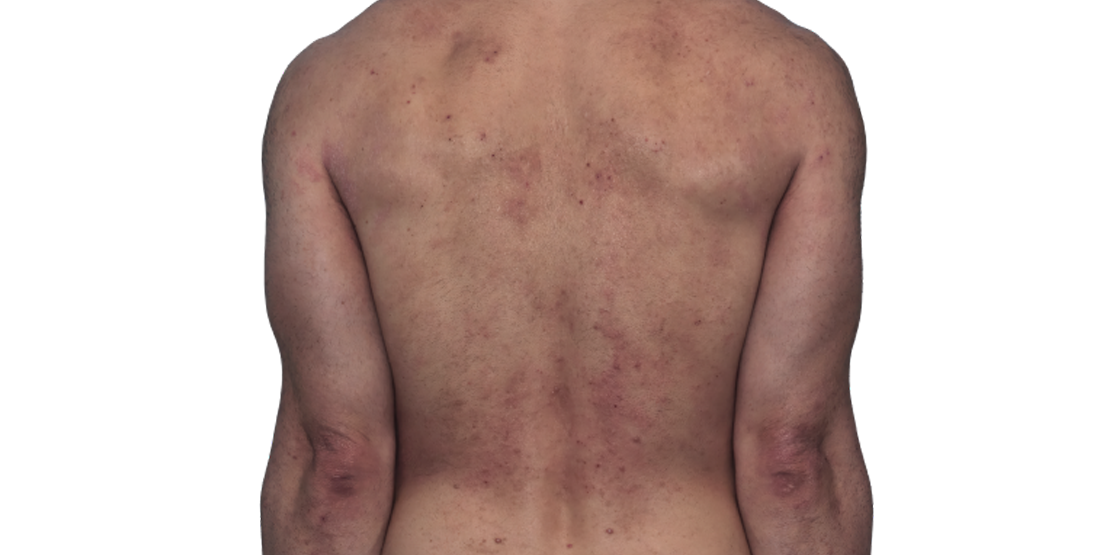 Actual 42-year-old male patient at baseline with eczema (atopic dermatitis) on back and arms.