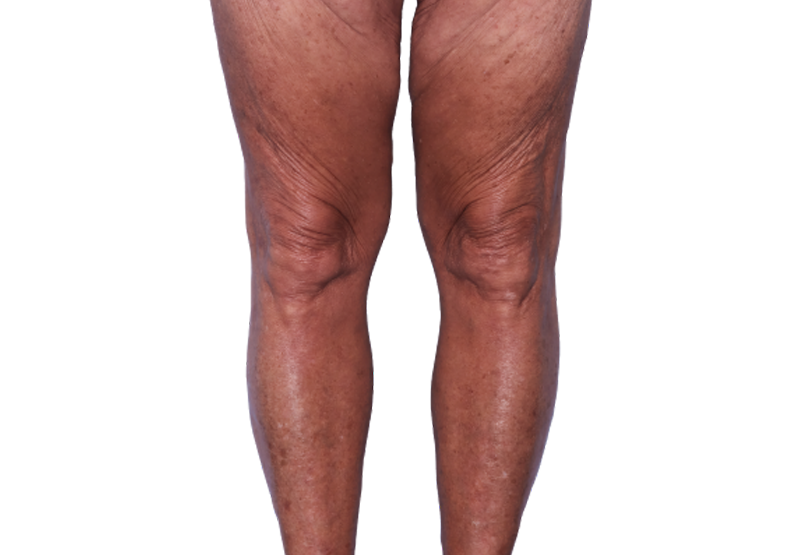 Actual 67-year-old female patient at Week 16 with improved eczema (atopic dermatitis) on legs.