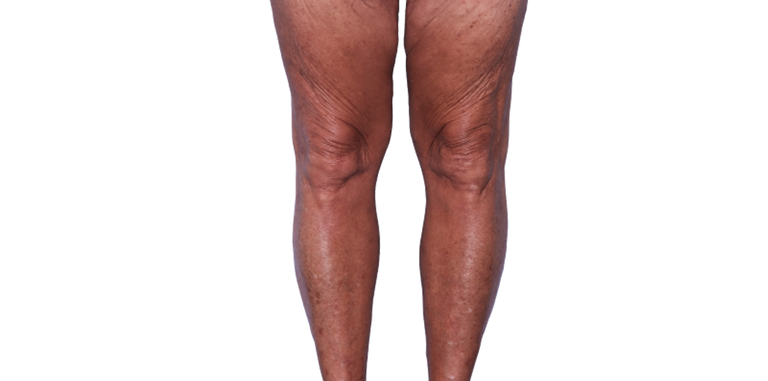 Actual 67-year-old female patient at Week 16 with improved eczema (atopic dermatitis) on legs.