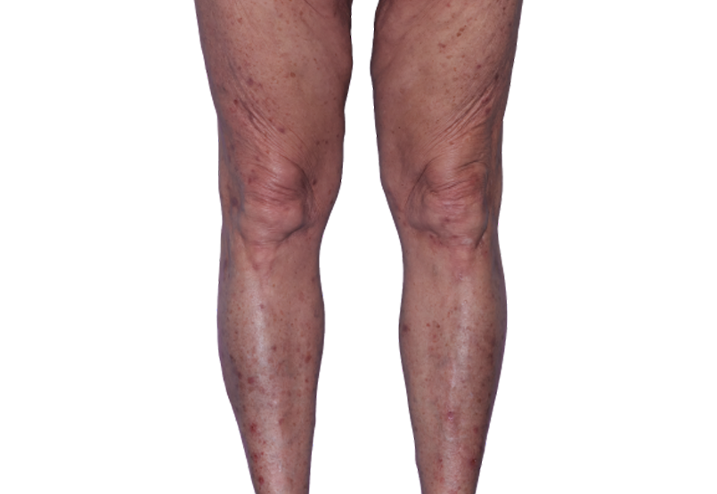 Actual 67-year-old female patient at baseline with eczema (atopic dermatitis) on legs.