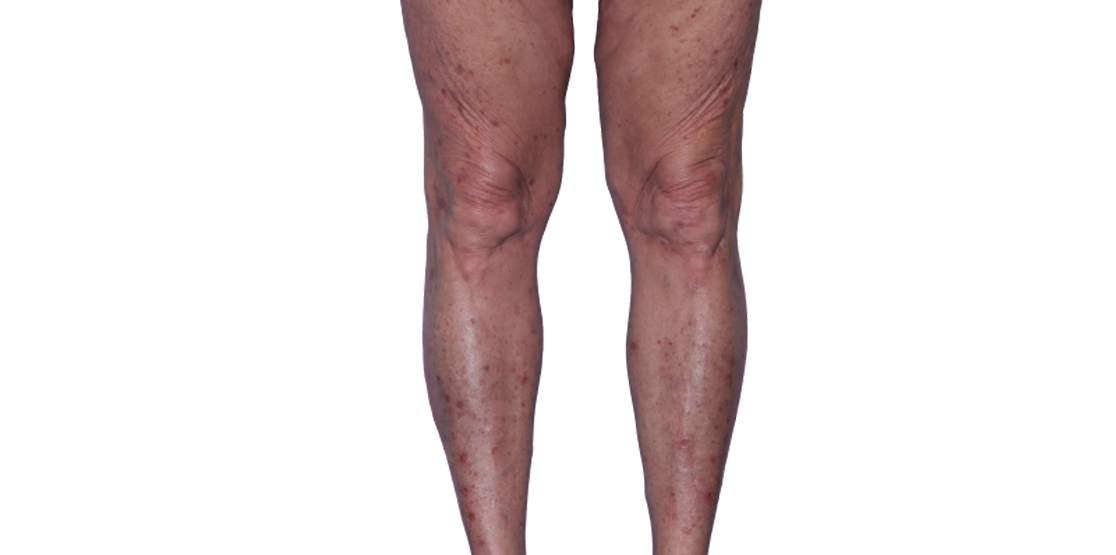 Actual 67-year-old female patient at baseline with eczema (atopic dermatitis) on legs.