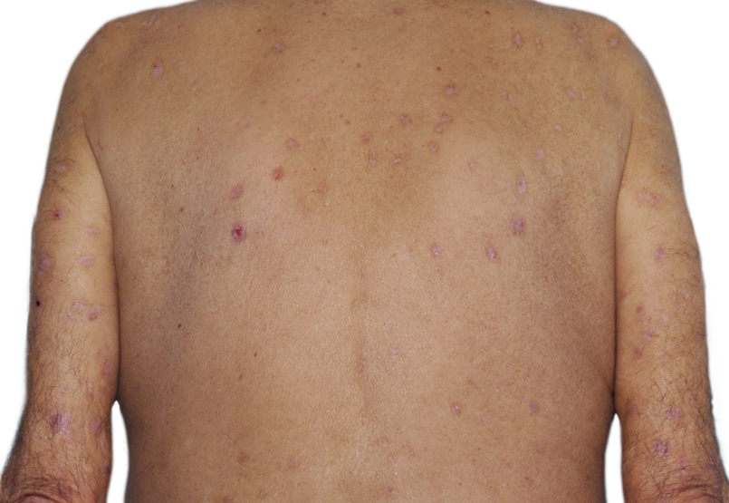 73-year-old male's back with reduced raised bumps and nodules after NEMLUVIO® (nemolizumab- ilto) treatment for prurigo nodularis (PN).