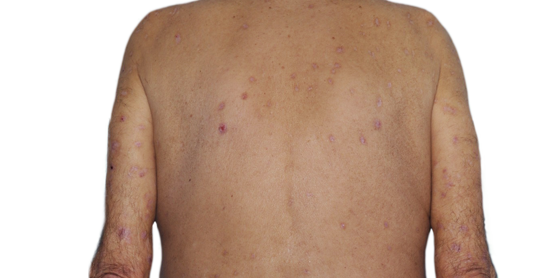 73-year-old male's back with reduced raised bumps and nodules after NEMLUVIO® (nemolizumab- ilto) treatment for prurigo nodularis (PN).