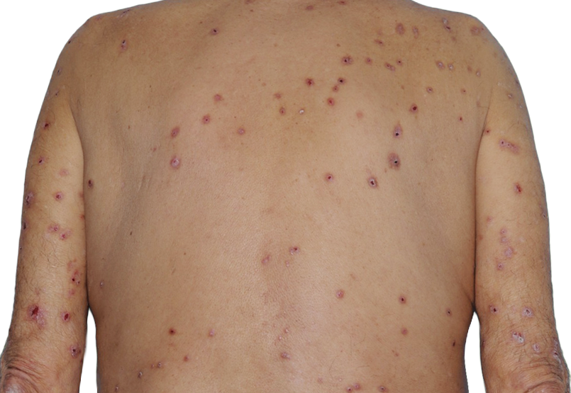 73-year-old male's back with raised bumps and nodules before NEMLUVIO® (nemolizumab-ilto) treatment for prurigo nodularis (PN).