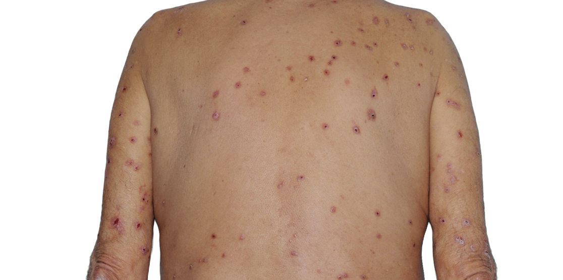 73-year-old male's back with raised bumps and nodules before NEMLUVIO® (nemolizumab-ilto) treatment for prurigo nodularis (PN).