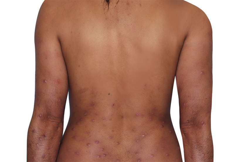 31-year-old female's back with raised bumps and nodules before NEMLUVIO® (nemolizumab-ilto) treatment for prurigo nodularis (PN).