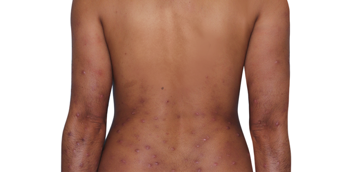 31-year-old female's back with raised bumps and nodules before NEMLUVIO® (nemolizumab-ilto) treatment for prurigo nodularis (PN).